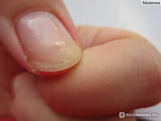 Слоятся ногти на руках: причины и лечение в домашних условиях