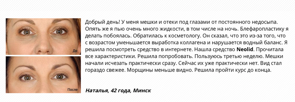 Мешки под глазами. Мешки под глазами отеки под глазами. Мешки под глазами от отеков. Убирание отеков под глазами.