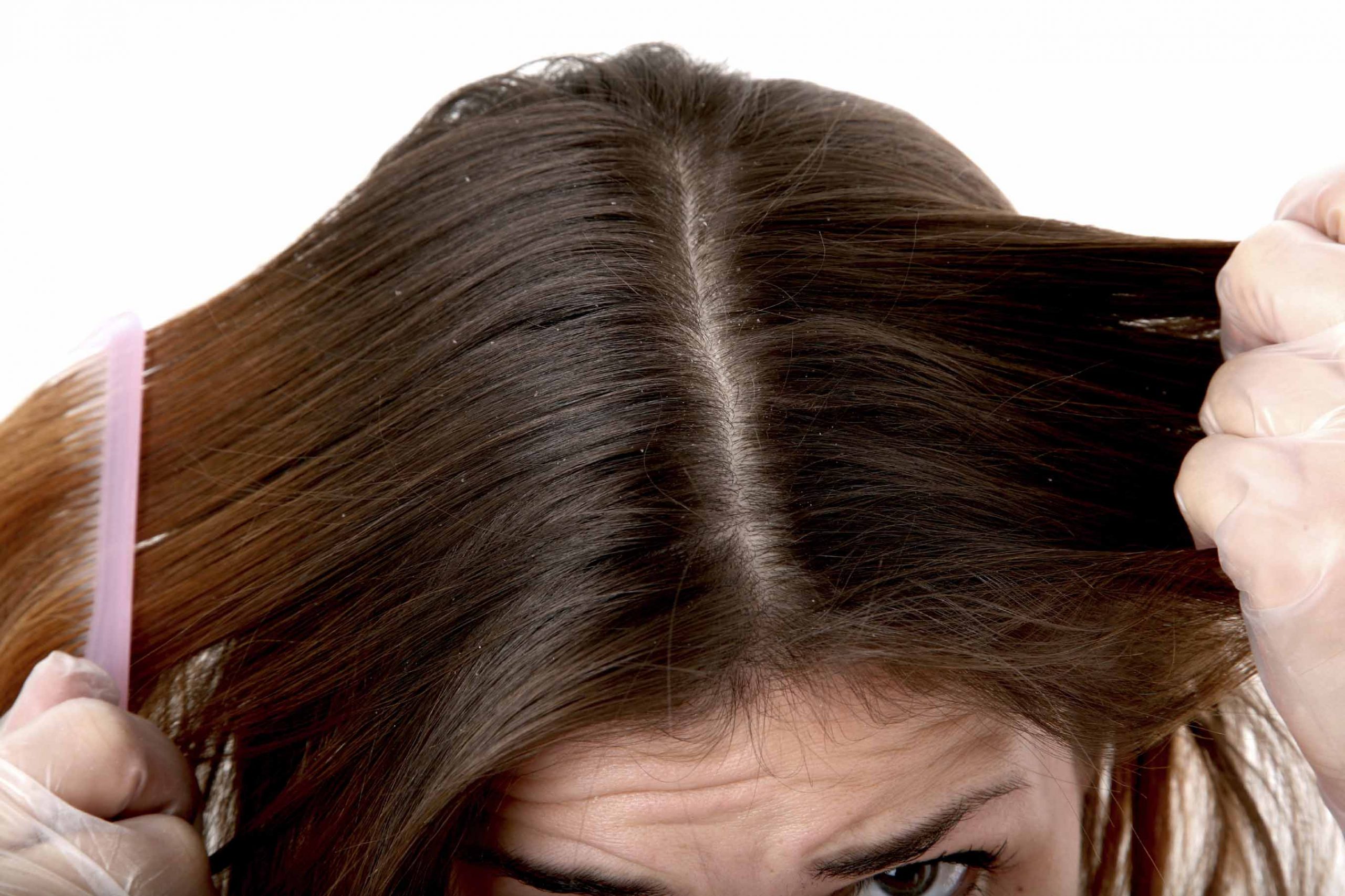 Почему волосы быстро становятся жирными и как с этим бороться у девушек