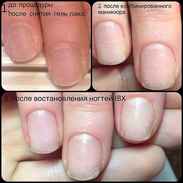 Как восстановить ногти в домашних условиях после травмы или повреждения