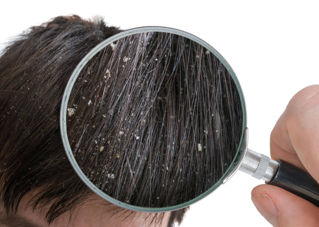 Как быстро избавиться от перхоти и выпадения волос в домашних условиях