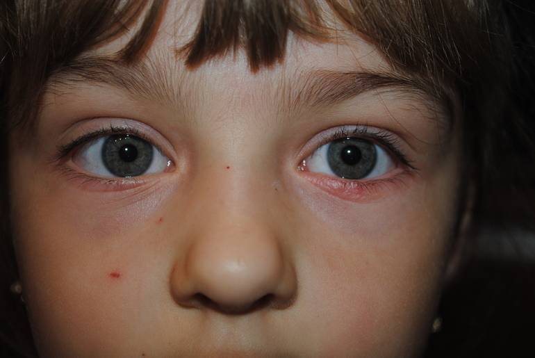 Красные круги под глазами у ребенка: причины и фото