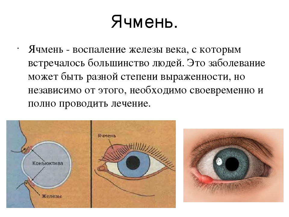 Искажение изображения в глазу причины и лечение