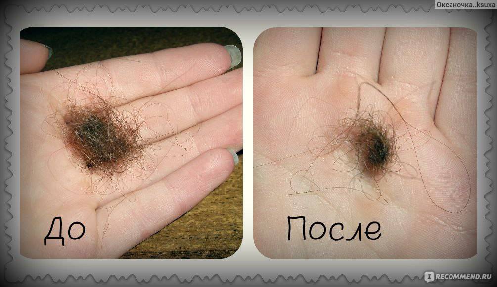 Сколько волос в день выпадает в норме у человека