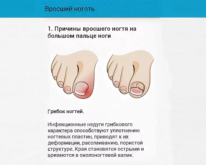 Боль при стрижке ногтей на ногах