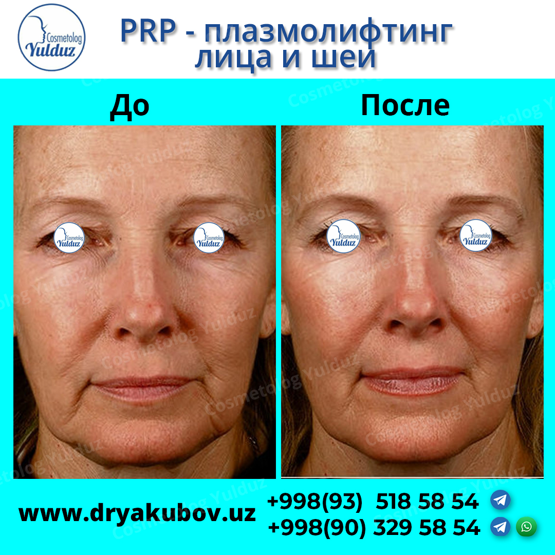Плазмолифтинг отзывы фото до и после лицо. Плазмолифтинг для лица. Плазма лифтин для лица. Плазмотерапия до и после. Плазмолифтинг лица до и после.