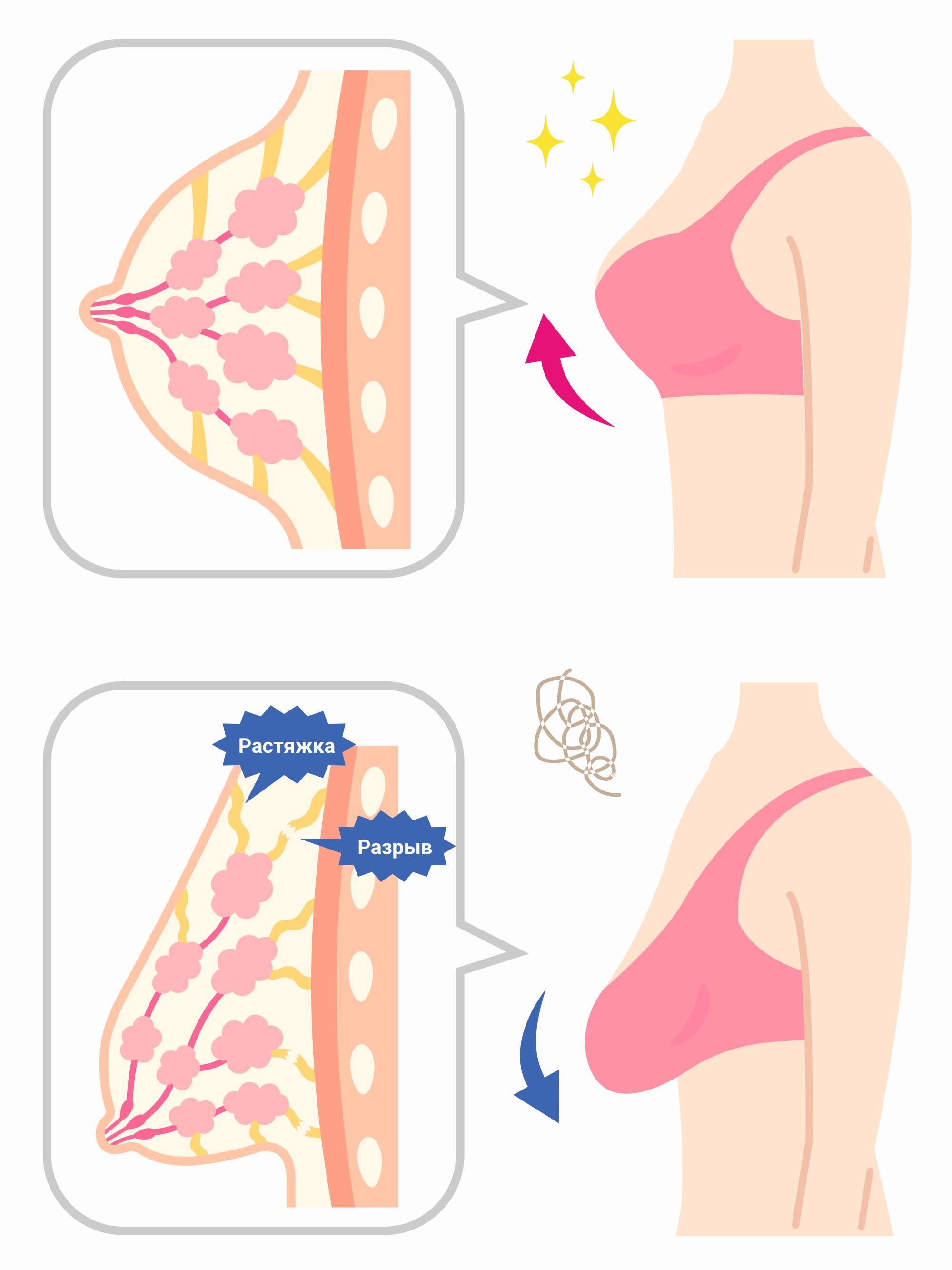 Мастопексия - пластическая операция по подтяжке груди