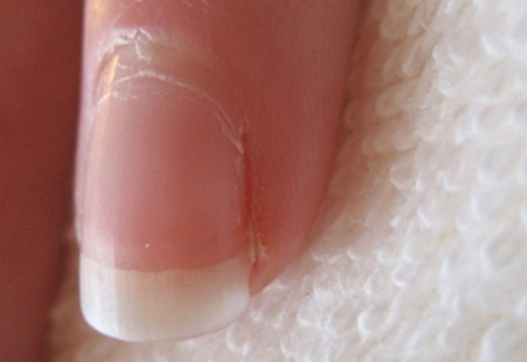 Паронихия - воспаление вокруг ногтя: как убрать покраснение?